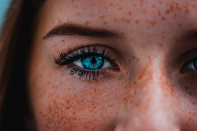 Freckles